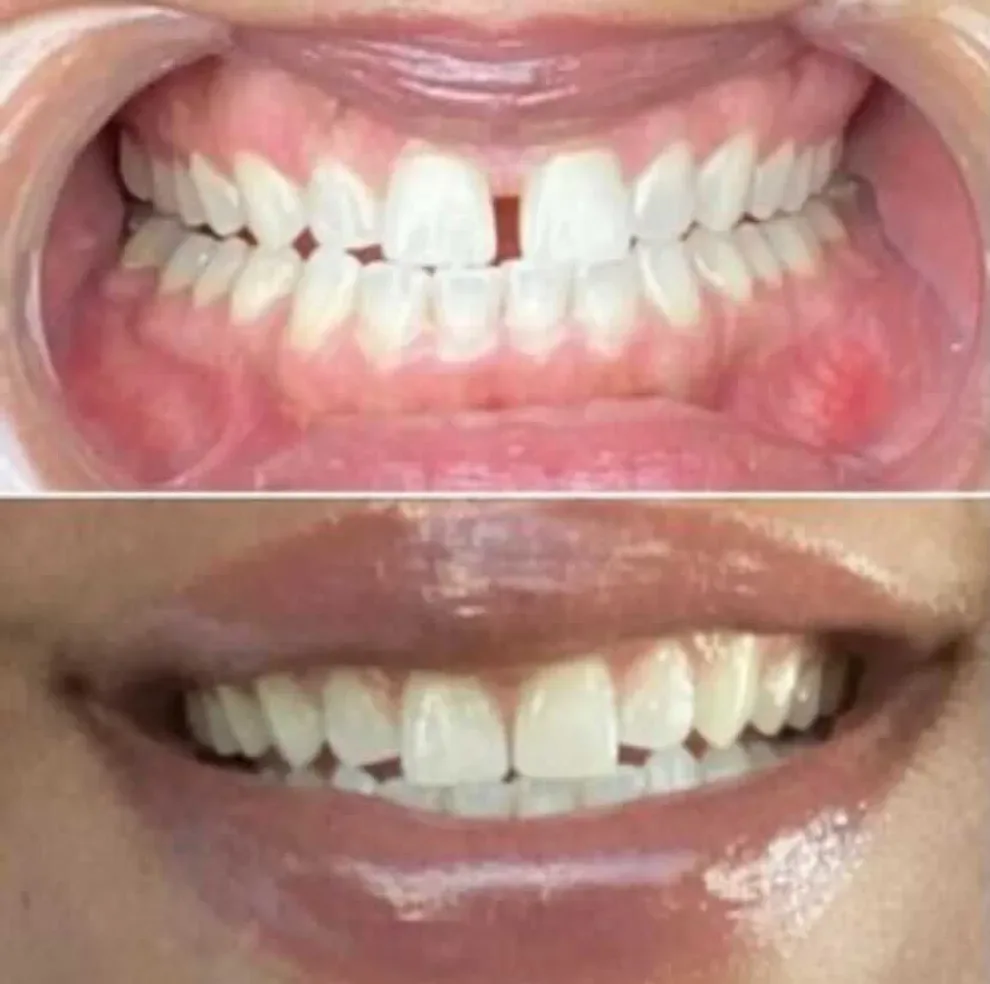 fixing gap teeth