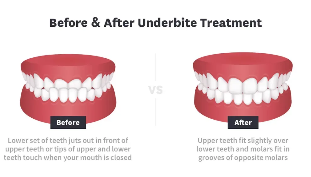 before and after underbite treatment