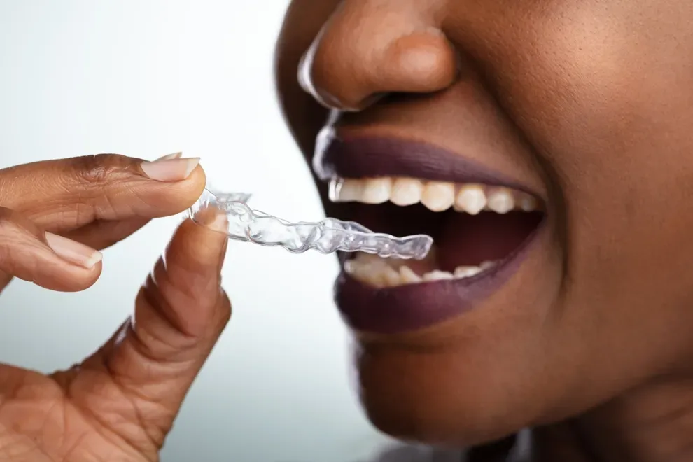 byte-vs-invisalign-aligners