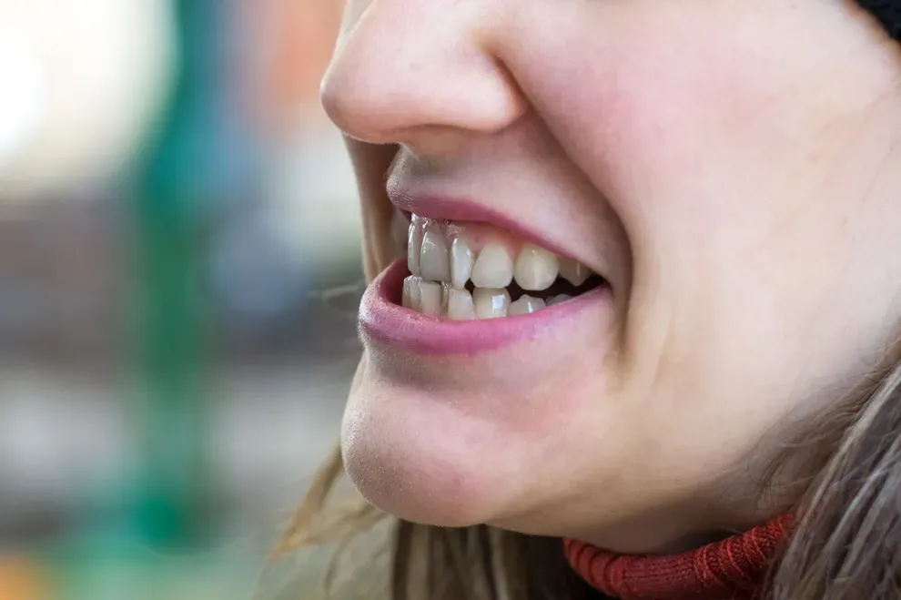 can-overlapping-teeth-be-straightened