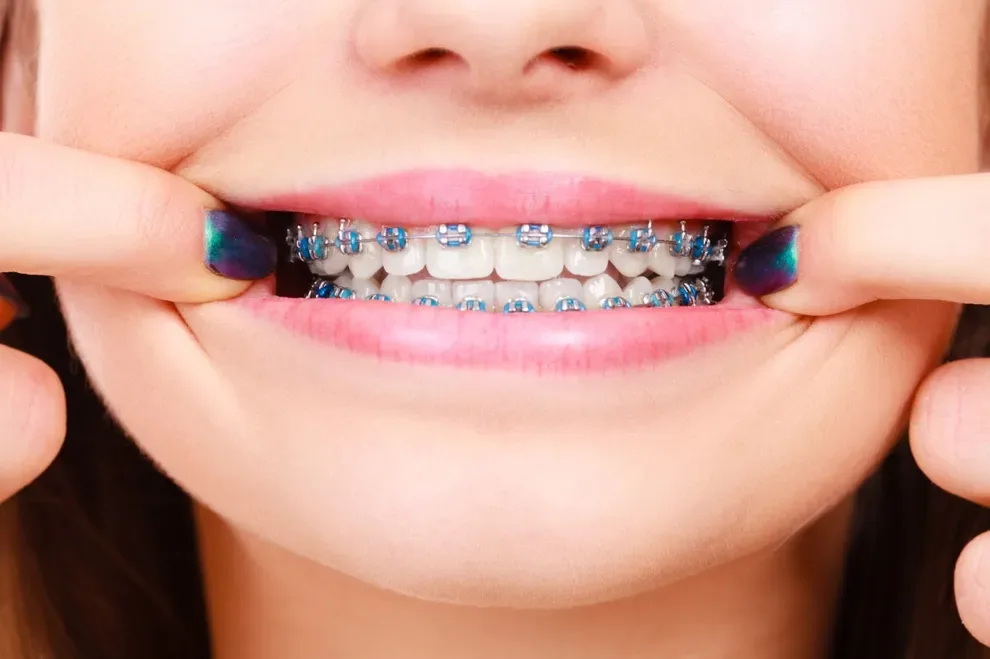 gaps-after-braces