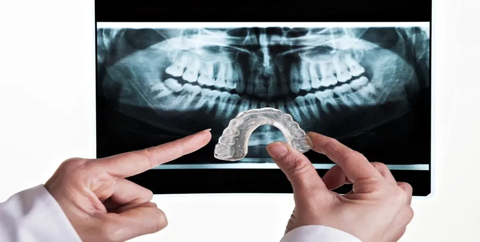 malocclusion-treatment