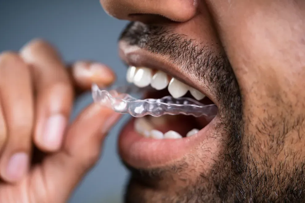 man-putting-in-invisalign