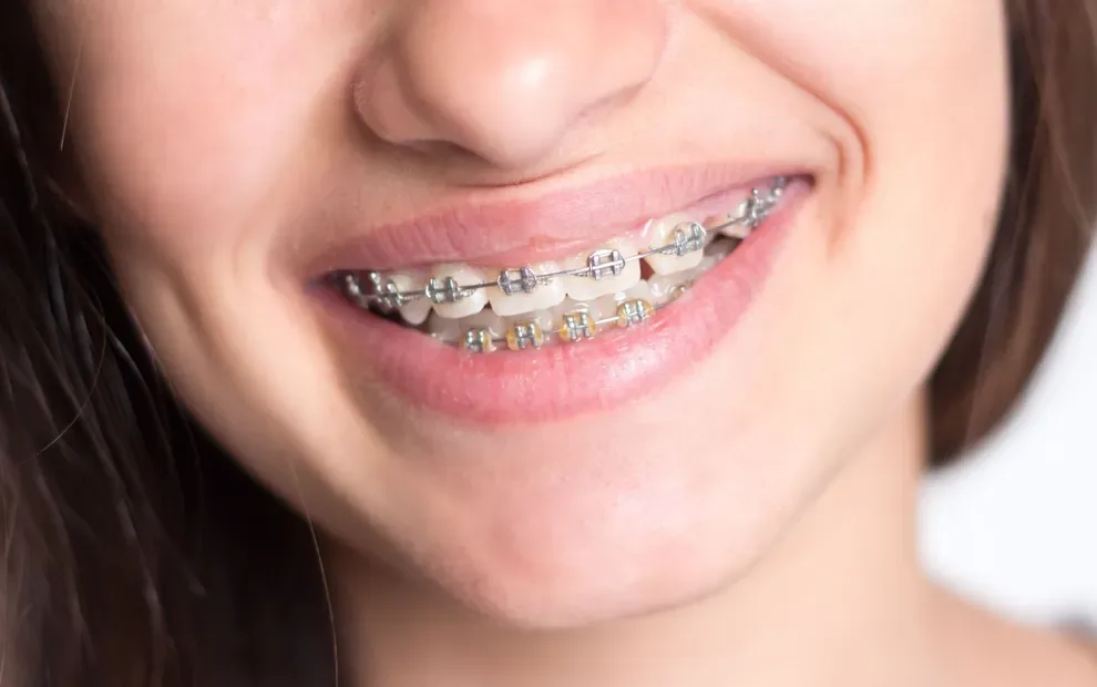 monthly-cost-braces