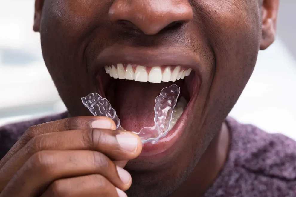 teeth-aligners-walmart-carries