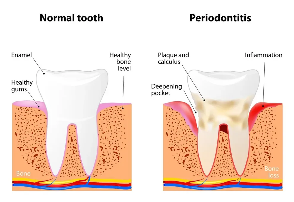 the-dangers-of-gum-disease