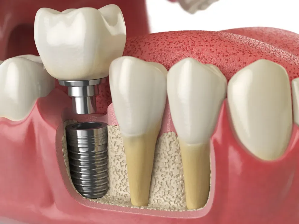 types-of-dental-implants