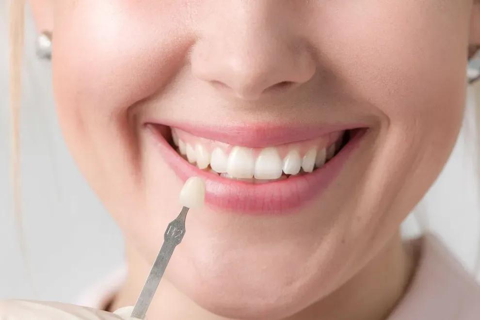 veneers-cost-guide