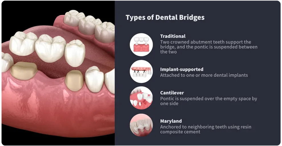 Types of Dental Bridges